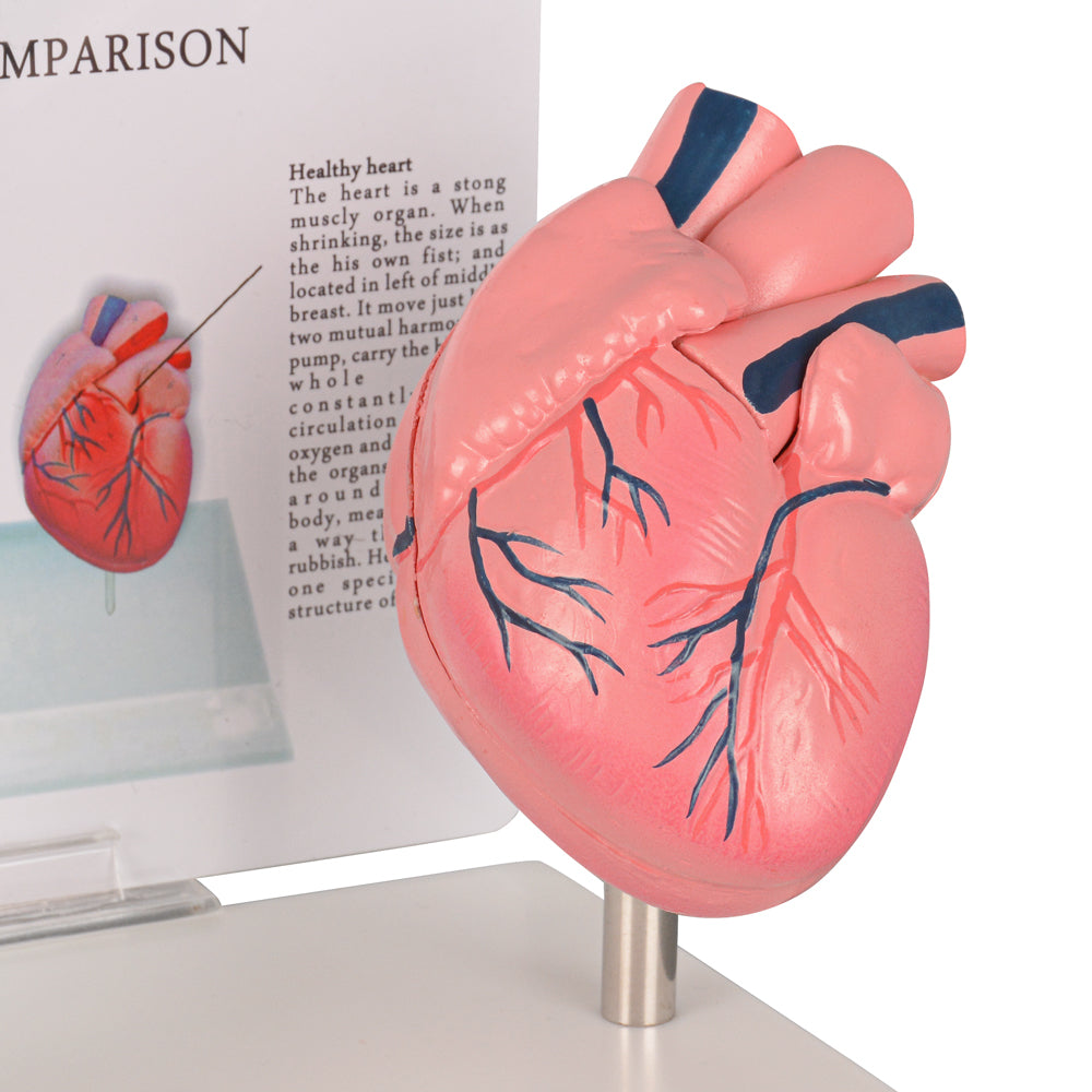 Healthy vs Smoker’s Heart Comparison Model