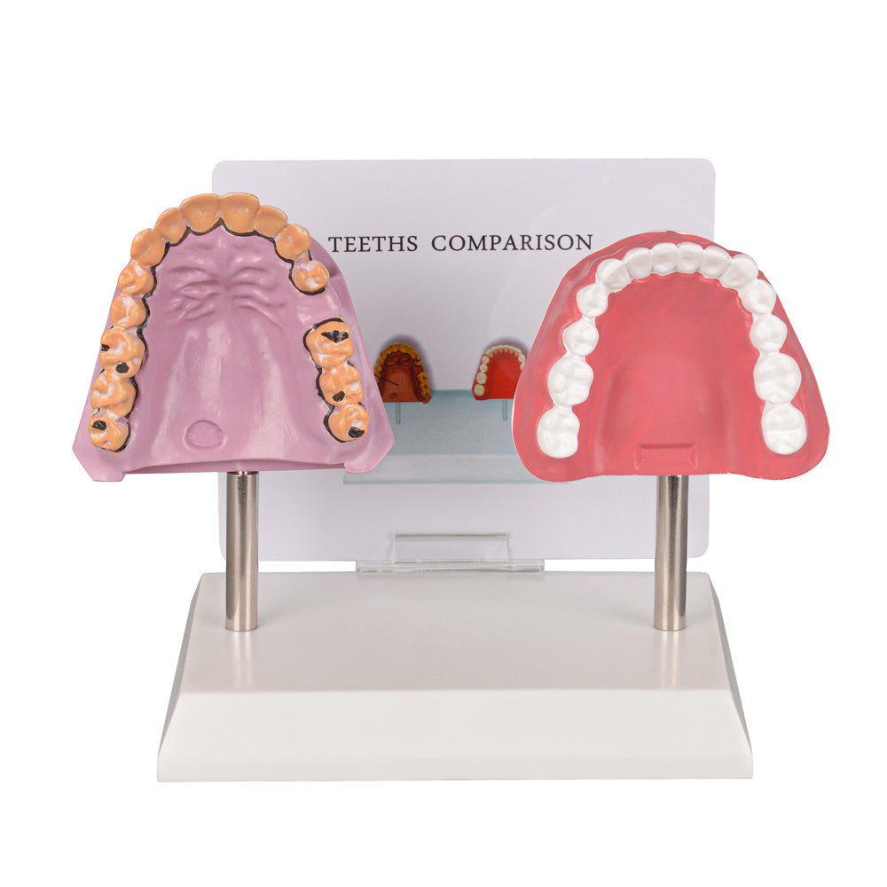 Healthy vs Smoker’s Mouth Comparison Model