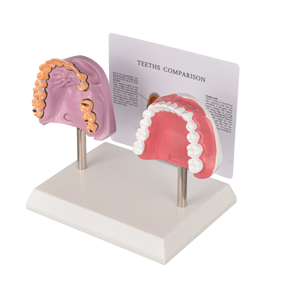 Healthy vs Smoker’s Mouth Comparison Model
