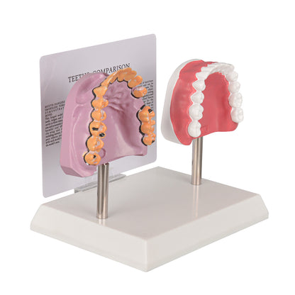 Healthy vs Smoker’s Mouth Comparison Model