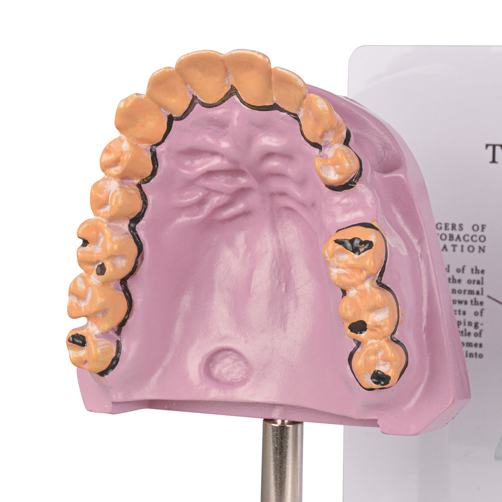 Healthy vs Smoker’s Mouth Comparison Model