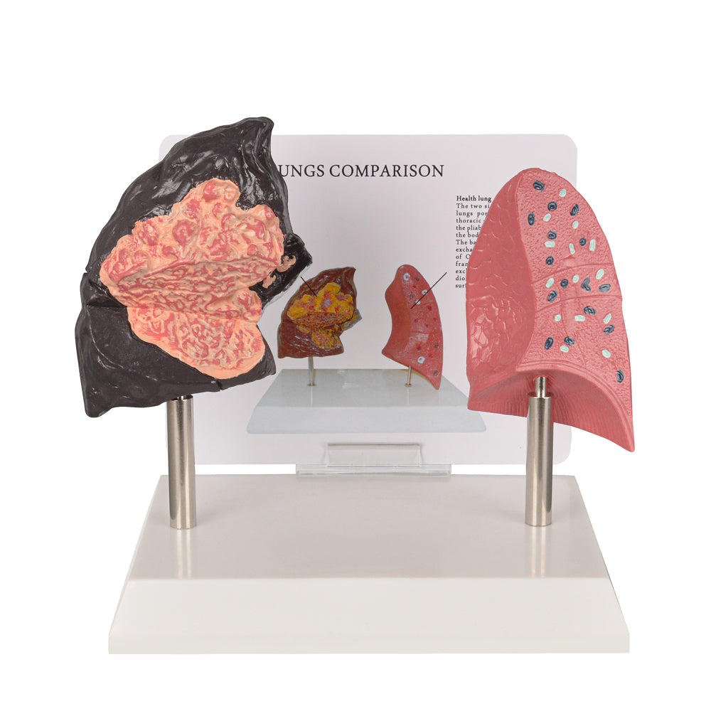 Healthy vs Smoker’s Lungs Comparison Display Model