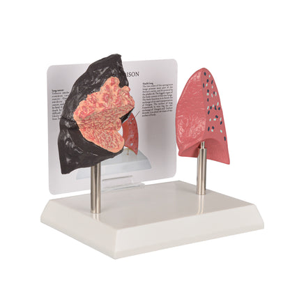 Healthy vs Smoker’s Lungs Comparison Display Model