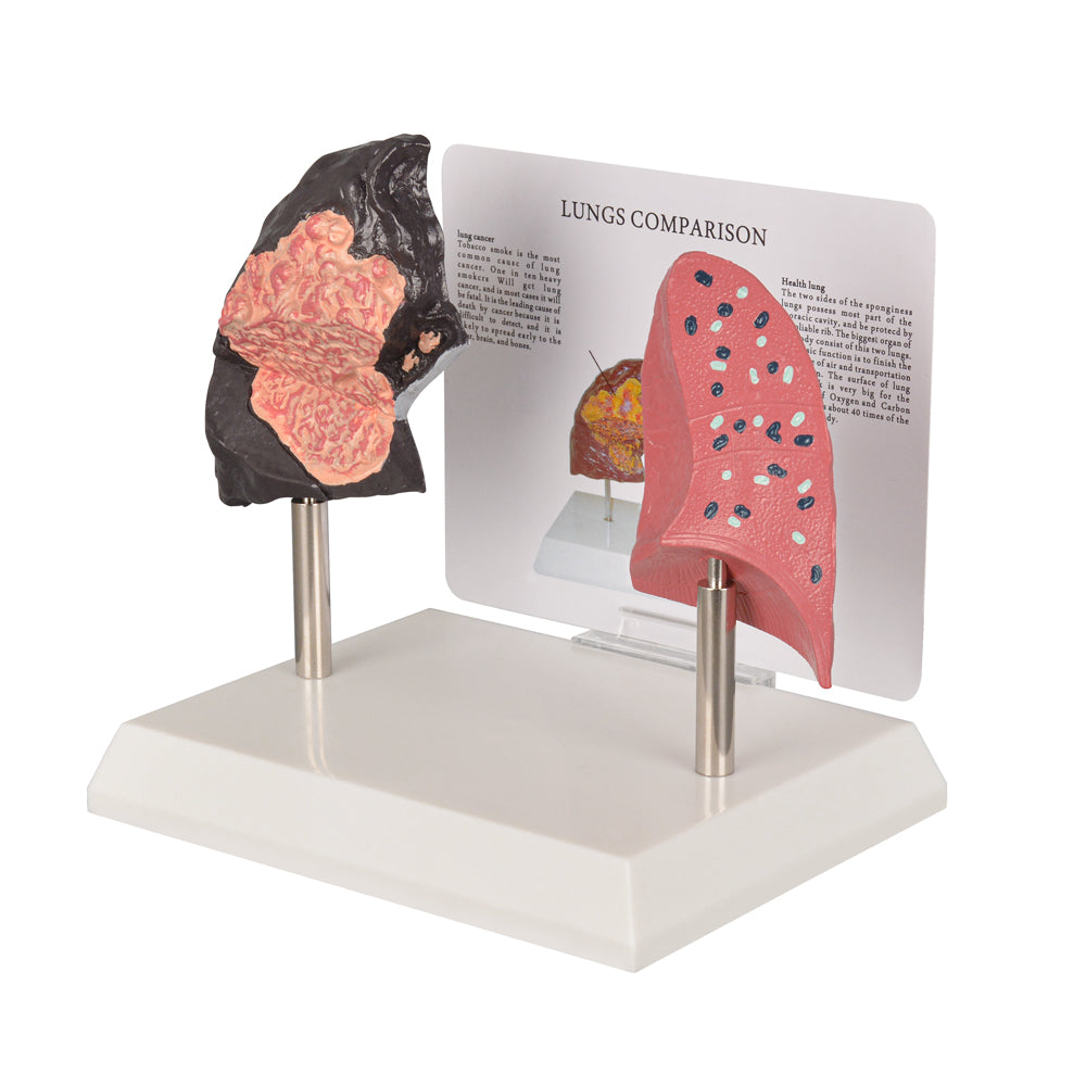 Healthy vs Smoker’s Lungs Comparison Display Model