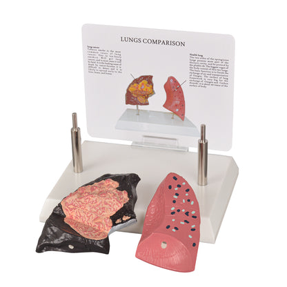 Healthy vs Smoker’s Lungs Comparison Display Model