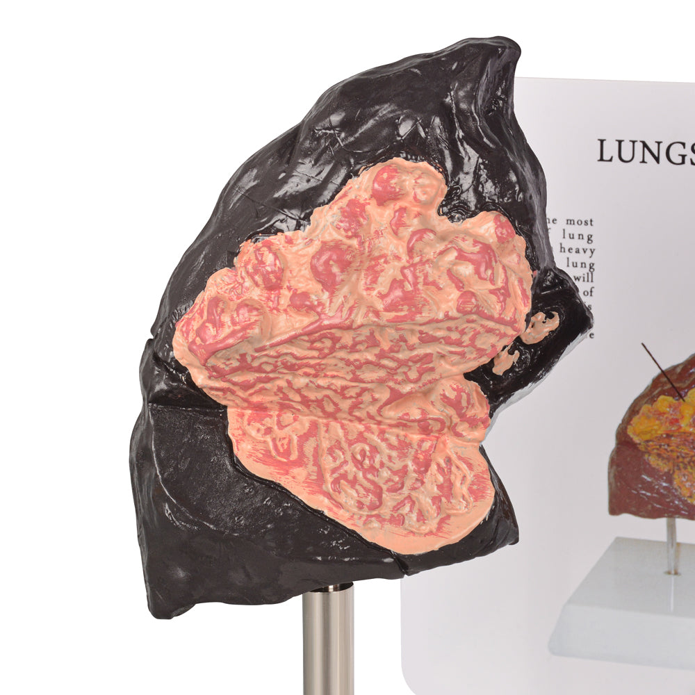Healthy vs Smoker’s Lungs Comparison Display Model