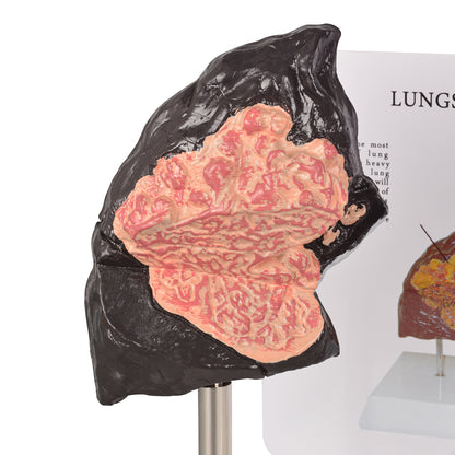 Healthy vs Smoker’s Lungs Comparison Display Model