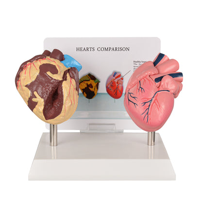 Healthy vs Smoker’s Heart Comparison Model