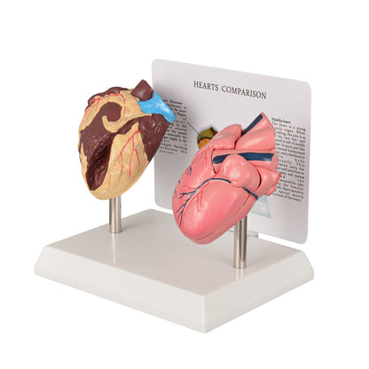 Healthy vs Smoker’s Heart Comparison Model
