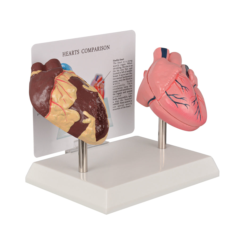 Healthy vs Smoker’s Heart Comparison Model