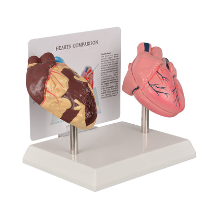 Healthy vs Smoker’s Heart Comparison Model