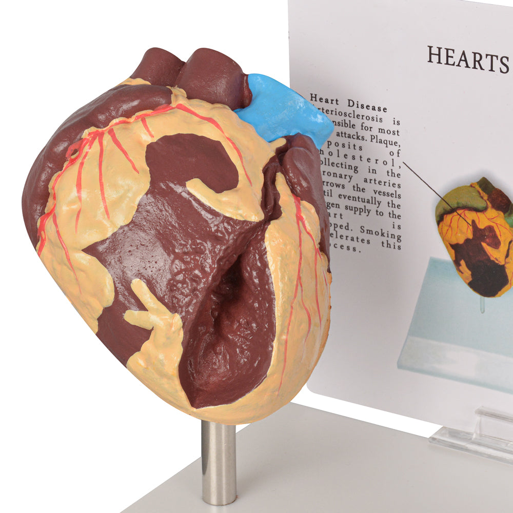 Healthy vs Smoker’s Heart Comparison Model