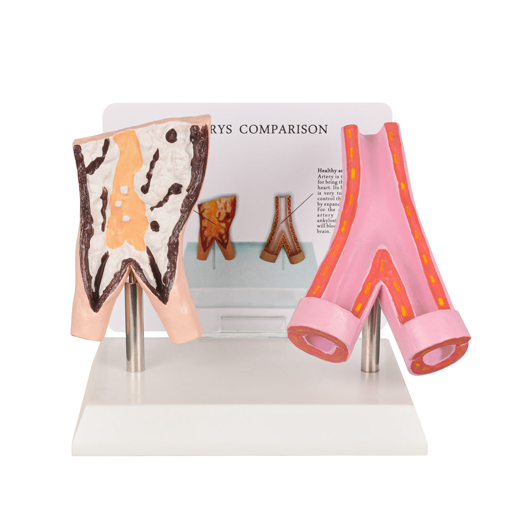 Healthy vs Smoker’s Vessels Comparison Model