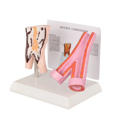 Healthy vs Smoker’s Vessels Comparison Model