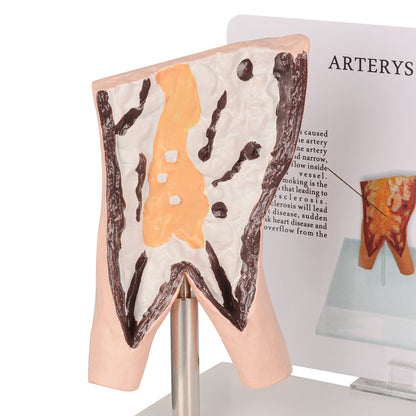 Healthy vs Smoker’s Vessels Comparison Model