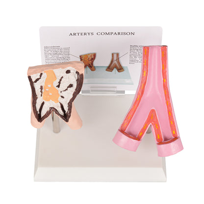 Healthy vs Smoker’s Vessels Comparison Model