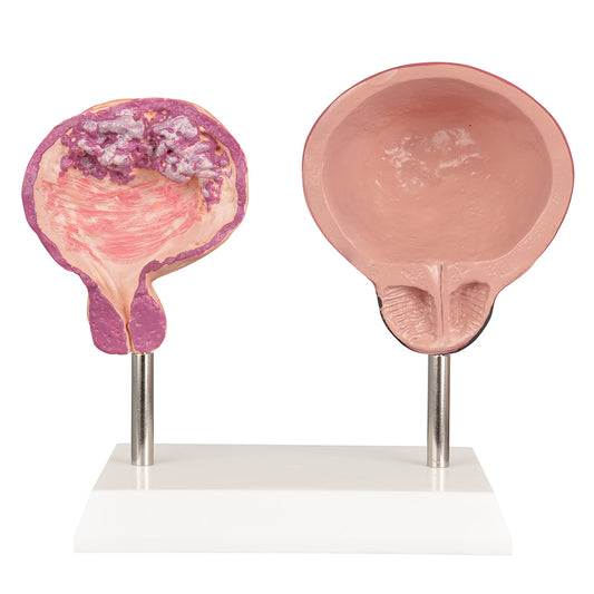 Healthy vs Smoker’s Bladder Model